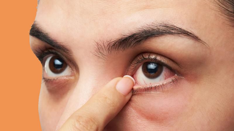 Tìm hiểu các mẹo chữa lẹo mắt hiệu quả và dễ làm